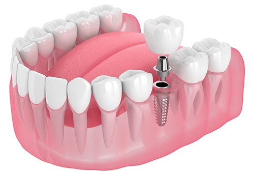 Illustration of a single dental implant
