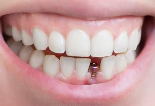 Smile with dental implant