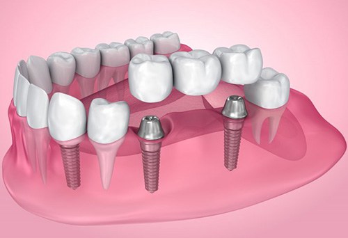 Exploded illustration of dental implants with bridge