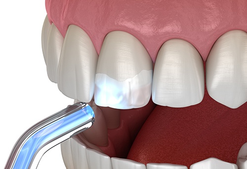 Digital image of direct bonding onto tooth