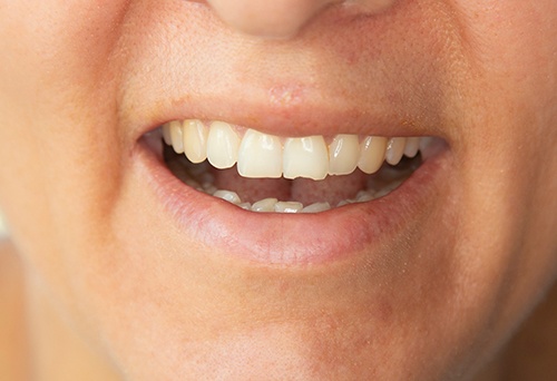 Up-close view of a chipped tooth