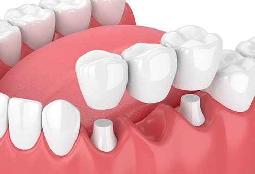 Illustration of traditional dental bridge in lower arch with white background