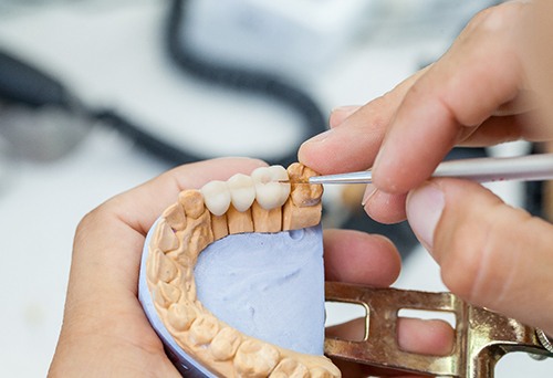 Lab tech’s hands building dental bridge on model teeth