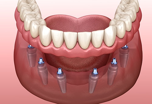 Illustration of six dental implants in lower arch to anchor dentures