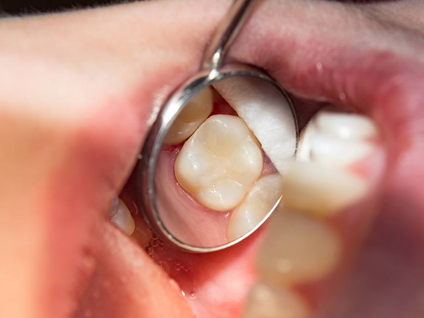 Closeup of someone’s tooth reflected in dental mirror