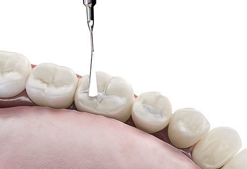 Rendering of tooth-colored resin being applied to fill cavity