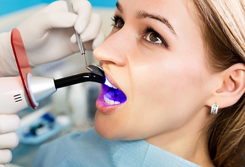 Dentist applying UV light to woman’s filling