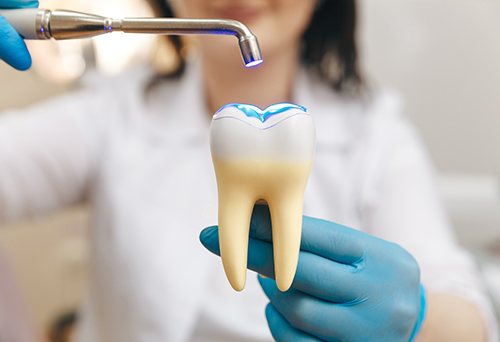 Dentist in blue gloves demonstrating resin filling on model tooth