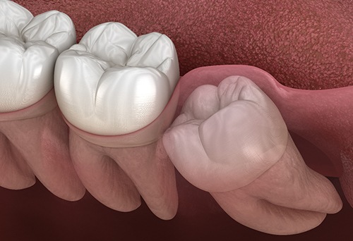 Illustration of wisdom tooth growing in sideways 