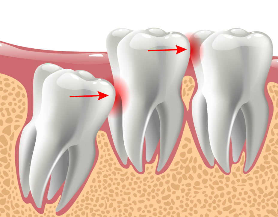Illustrated cross section of wisdom teeth
